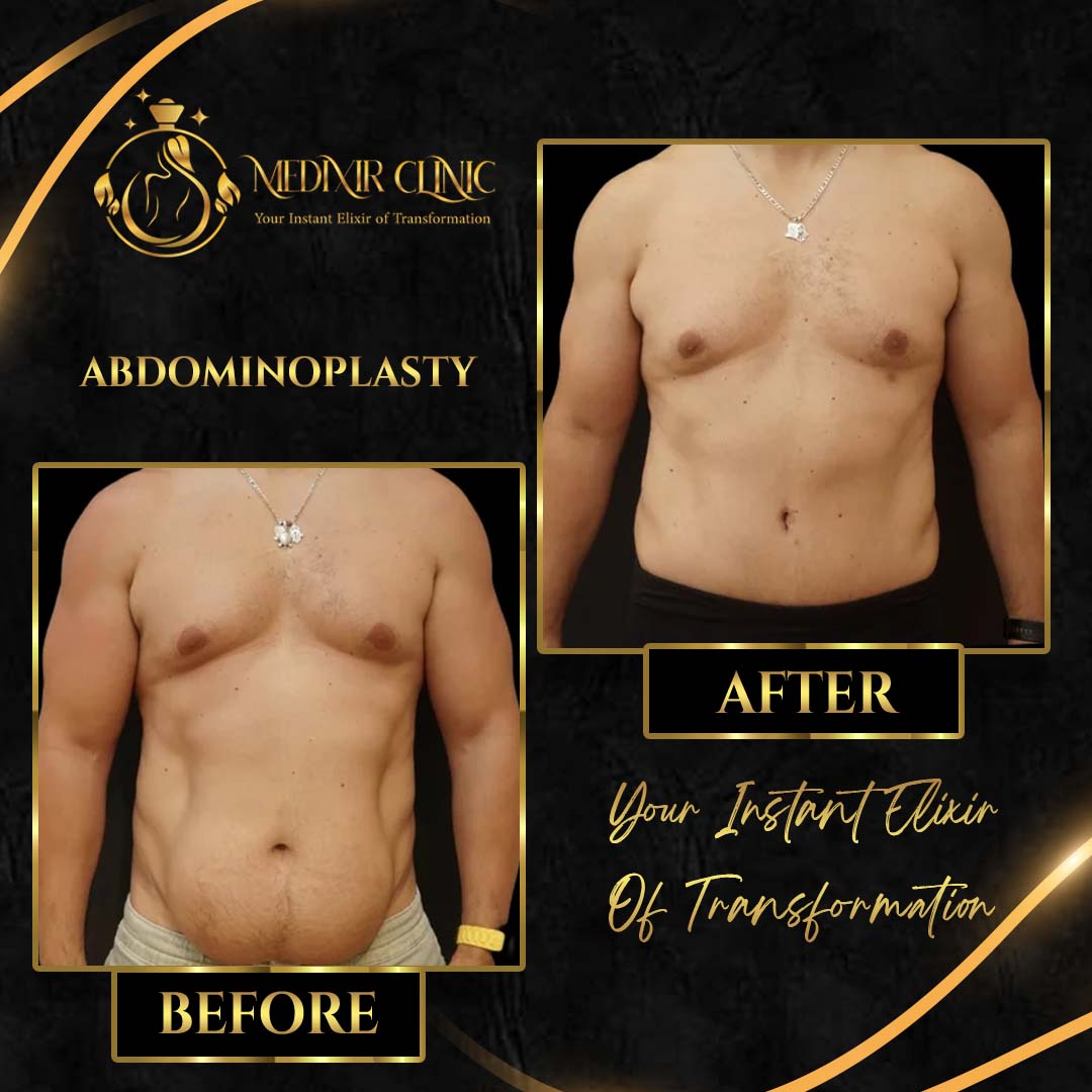 Abdominoplasty (Tummy Tuck)