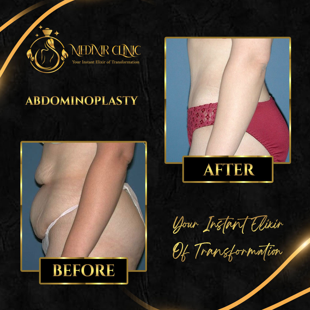 abdominoplasty8.jpg