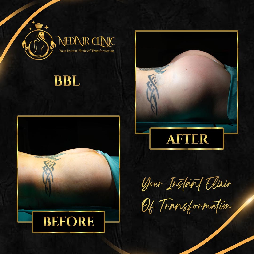 Brazilian Butt Lift (BBL) in Istanbul