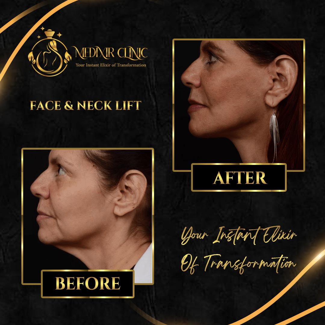 Face & Neck Lift