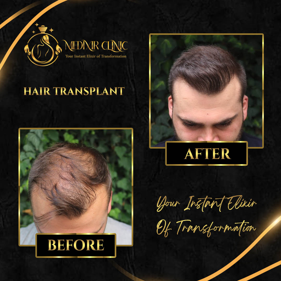 Hair Transplant DHI Sapphire FUE