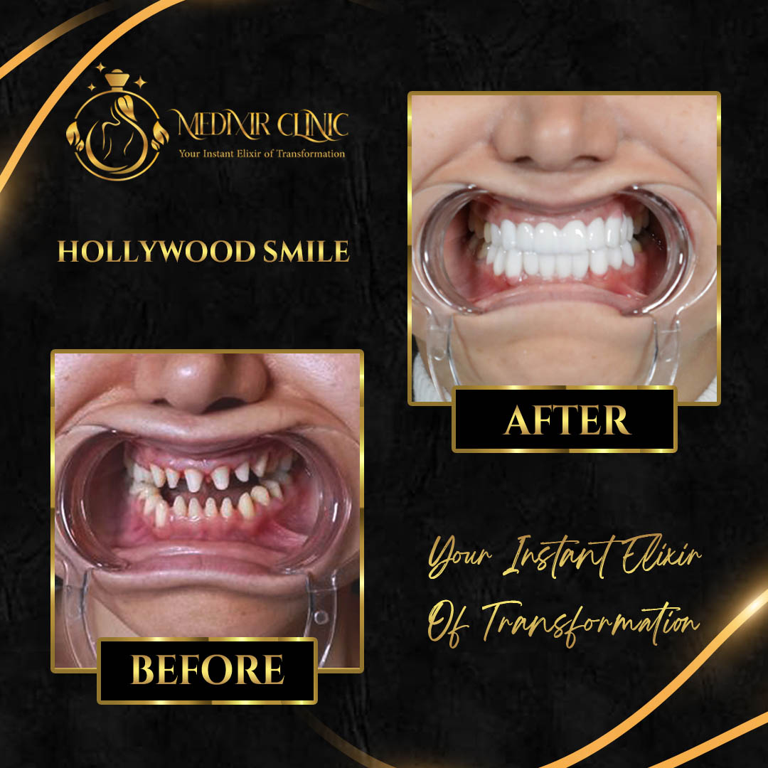 Hollywood Smile veneers
