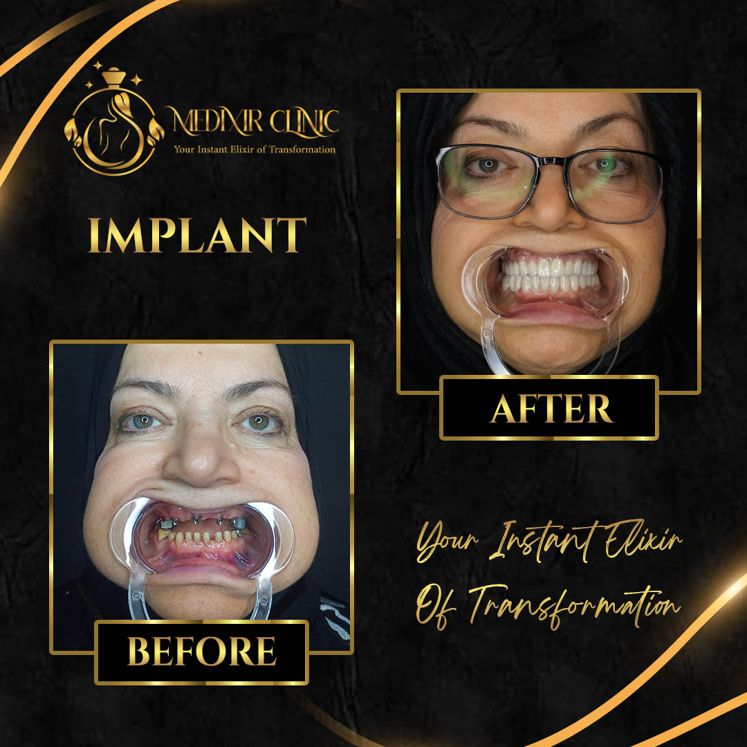 Dental Implants in Istanbul