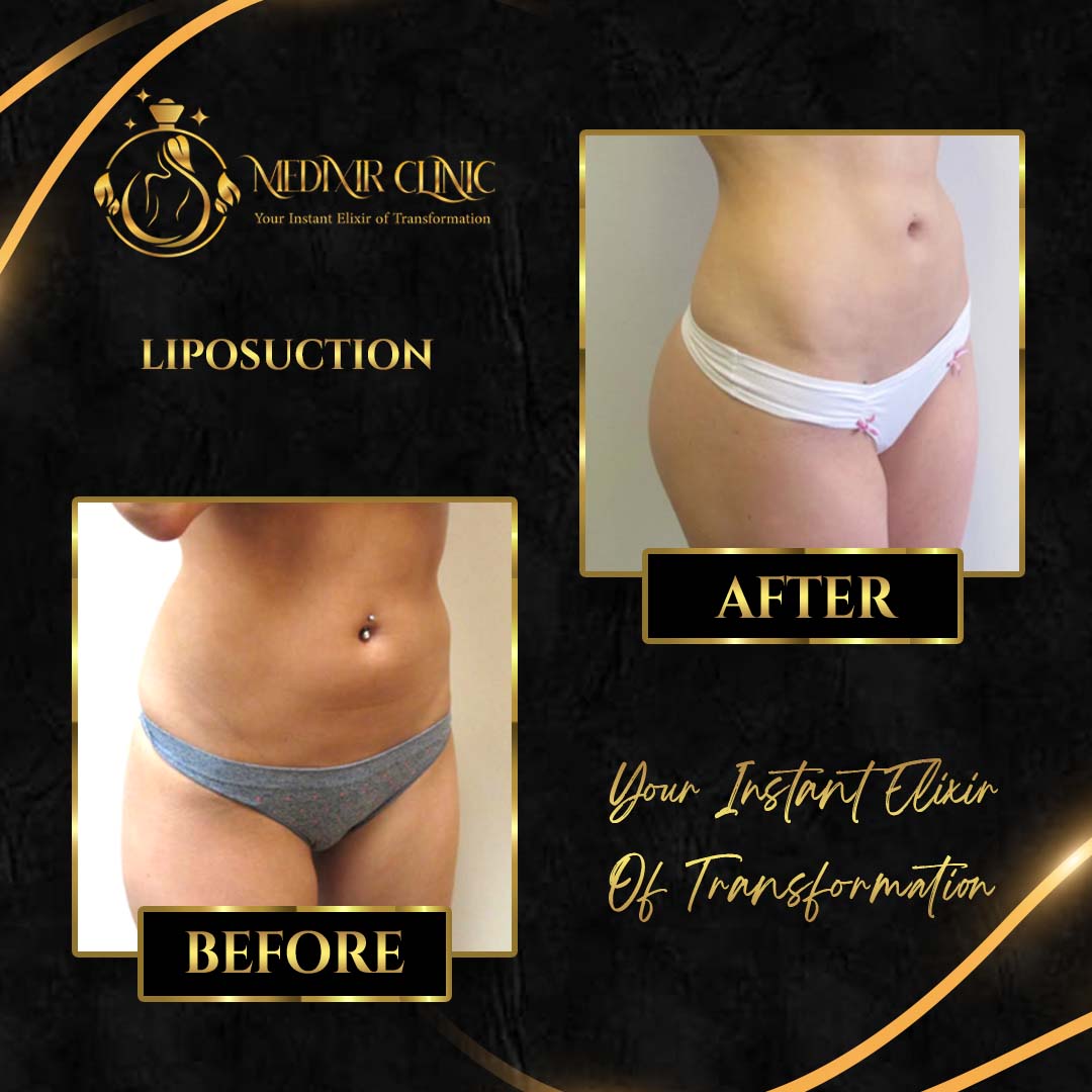 liposuction3.jpg